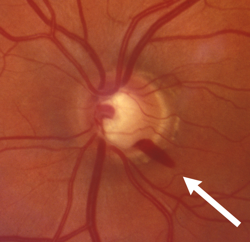 zoom in of optic disc hemorrhage